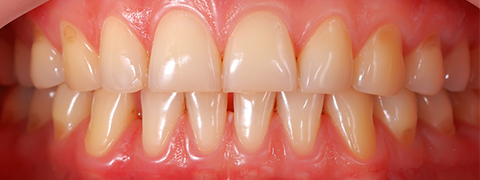 Dental veneers