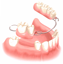 Partial denture for teeth